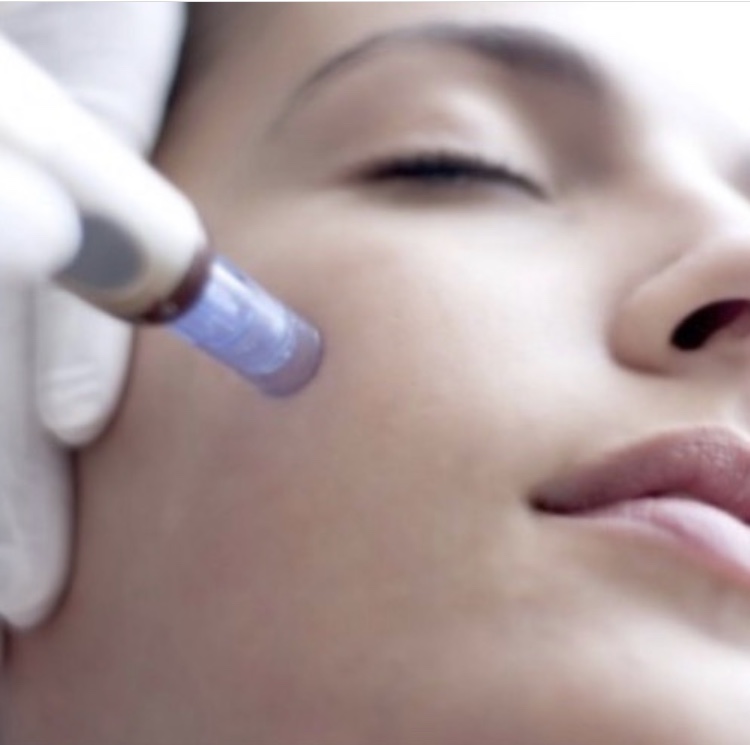 Microneedling