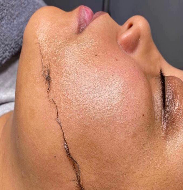 Dermaplaning à cholet