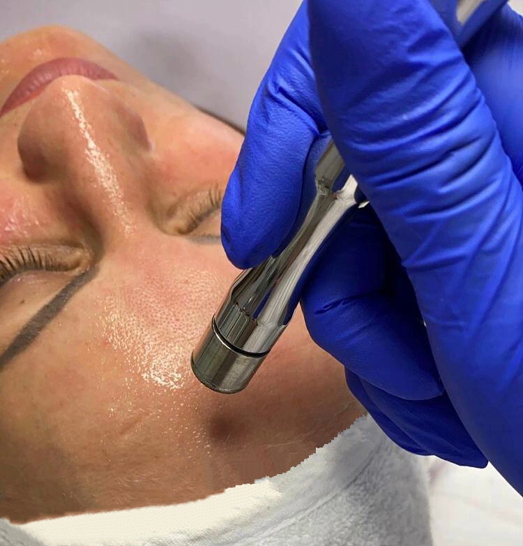 Microdermabrasion à cholet